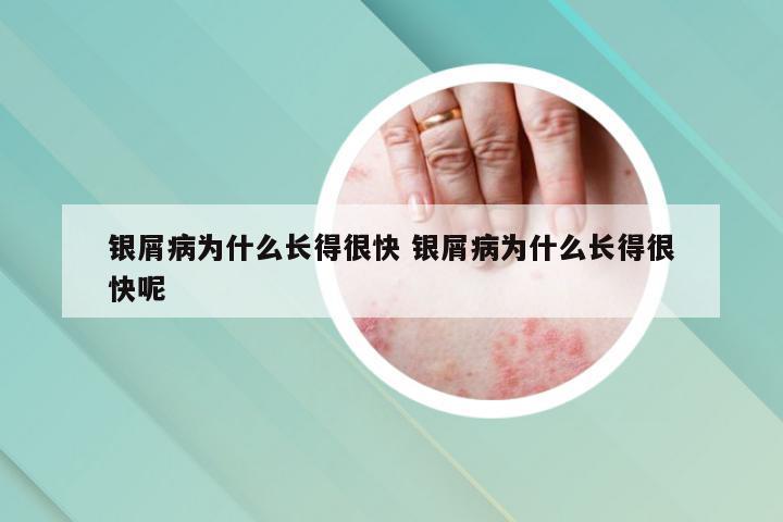 银屑病为什么长得很快 银屑病为什么长得很快呢