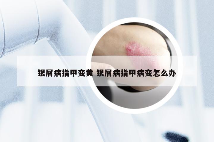 银屑病指甲变黄 银屑病指甲病变怎么办
