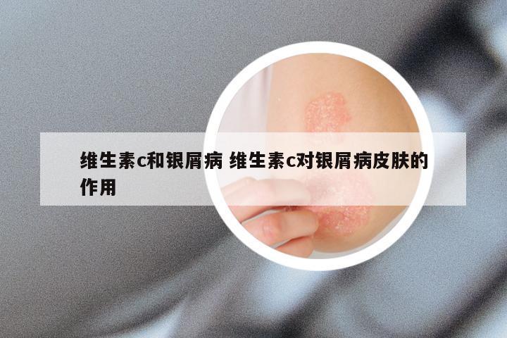 维生素c和银屑病 维生素c对银屑病皮肤的作用