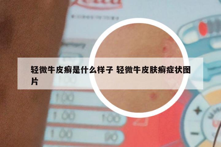轻微牛皮癣是什么样子 轻微牛皮肤癣症状图片