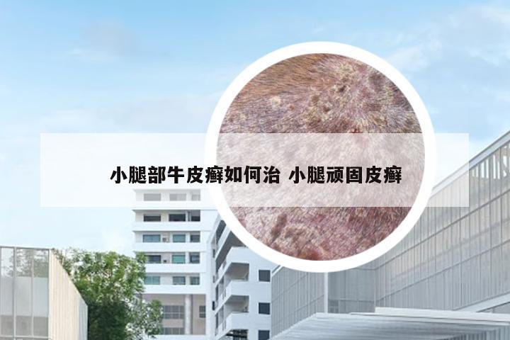 小腿部牛皮癣如何治 小腿顽固皮癣