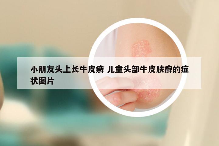 小朋友头上长牛皮癣 儿童头部牛皮肤癣的症状图片