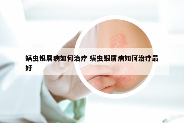 螨虫银屑病如何治疗 螨虫银屑病如何治疗最好