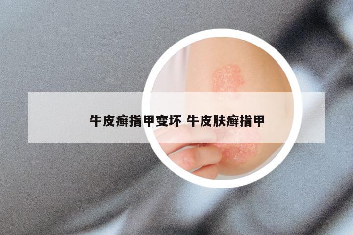 牛皮癣指甲变坏 牛皮肤癣指甲