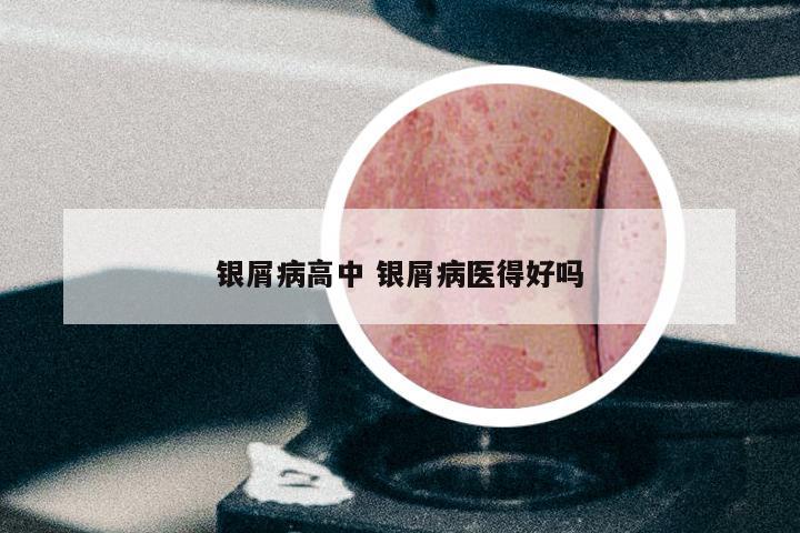 银屑病高中 银屑病医得好吗