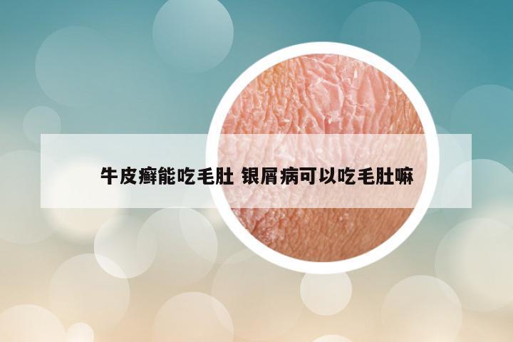 牛皮癣能吃毛肚 银屑病可以吃毛肚嘛