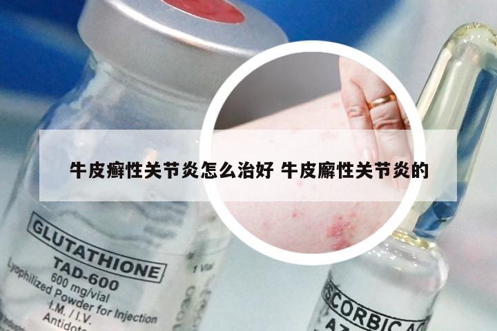 牛皮癣性关节炎怎么治好 牛皮廨性关节炎的