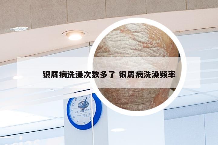 银屑病洗澡次数多了 银屑病洗澡频率