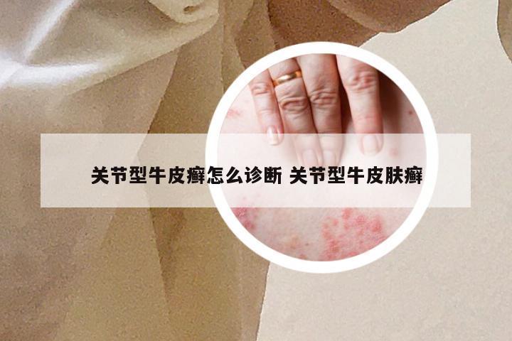关节型牛皮癣怎么诊断 关节型牛皮肤癣