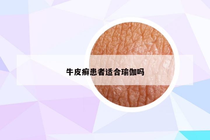 牛皮癣患者适合瑜伽吗