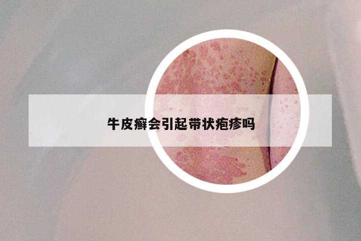 牛皮癣会引起带状疱疹吗