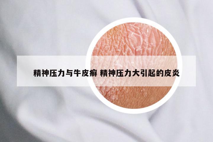 精神压力与牛皮癣 精神压力大引起的皮炎