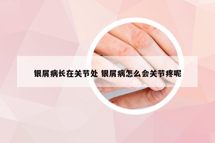 银屑病长在关节处 银屑病怎么会关节疼呢