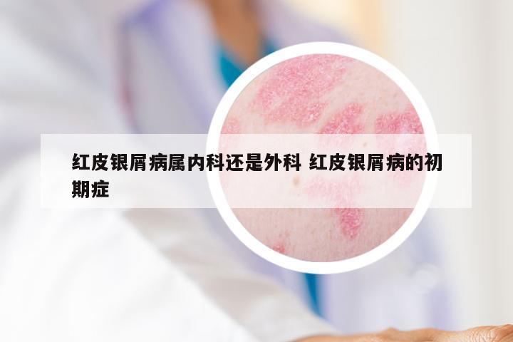 红皮银屑病属内科还是外科 红皮银屑病的初期症