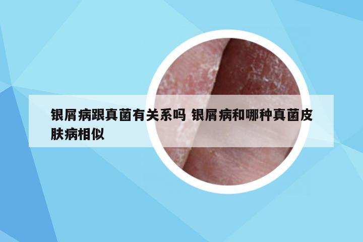 银屑病跟真菌有关系吗 银屑病和哪种真菌皮肤病相似
