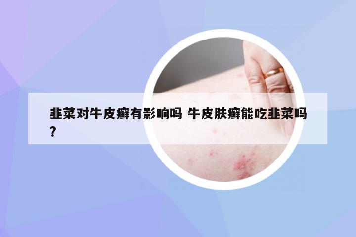 韭菜对牛皮癣有影响吗 牛皮肤癣能吃韭菜吗?
