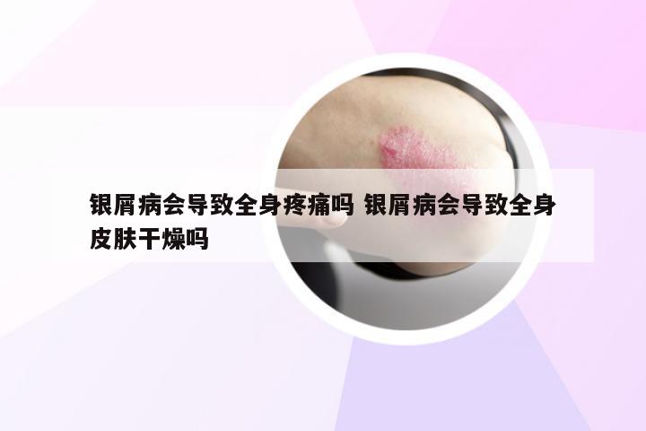 银屑病会导致全身疼痛吗 银屑病会导致全身皮肤干燥吗