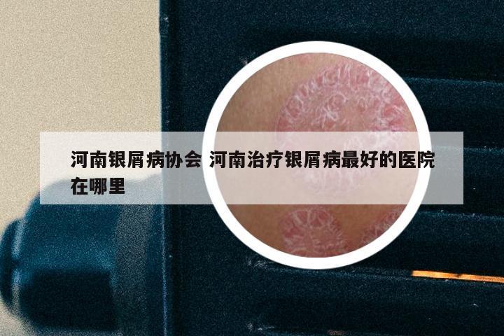 河南银屑病协会 河南治疗银屑病最好的医院在哪里