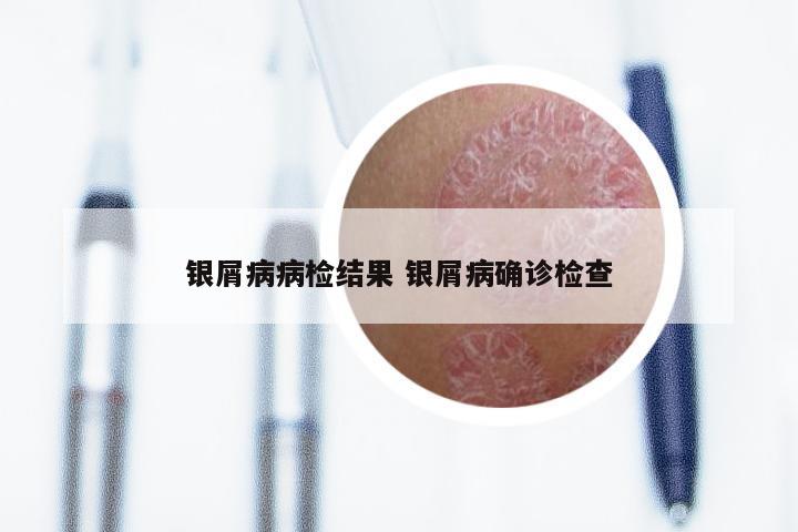 银屑病病检结果 银屑病确诊检查
