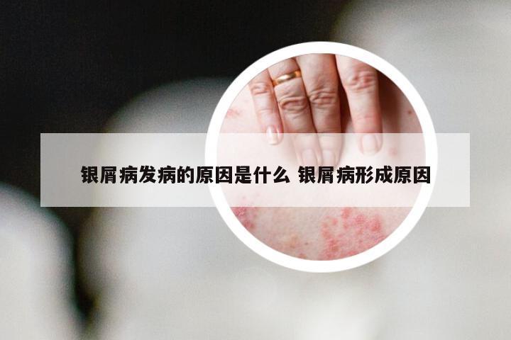 银屑病发病的原因是什么 银屑病形成原因