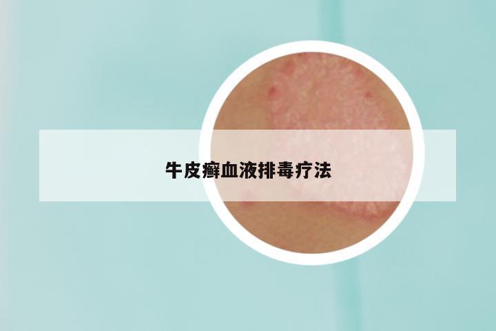 牛皮癣血液排毒疗法