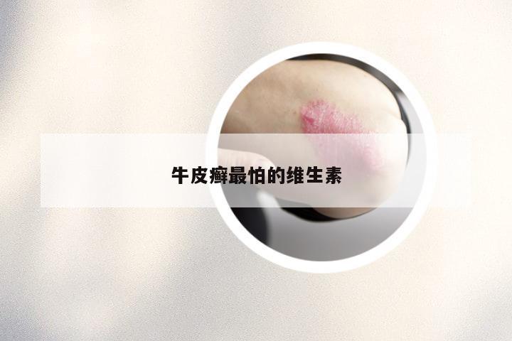 牛皮癣最怕的维生素