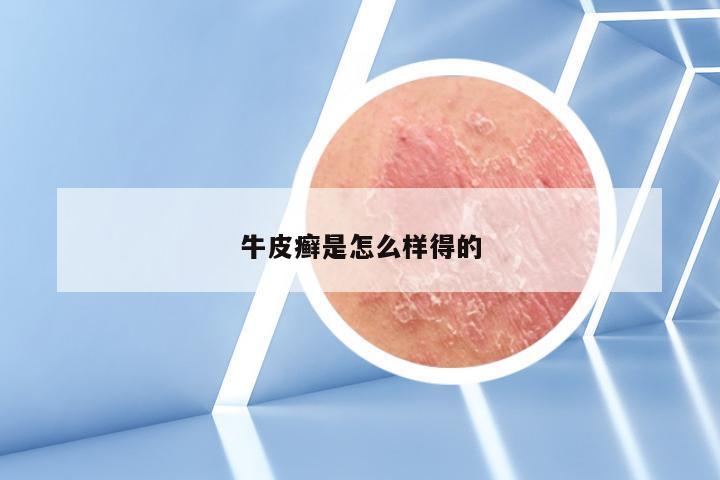 牛皮癣是怎么样得的