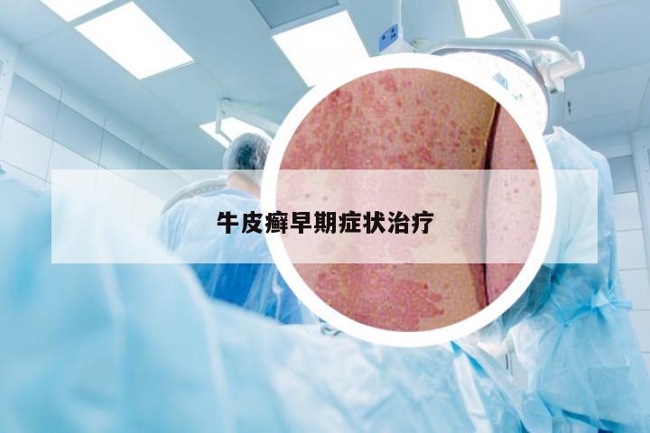 牛皮癣早期症状治疗
