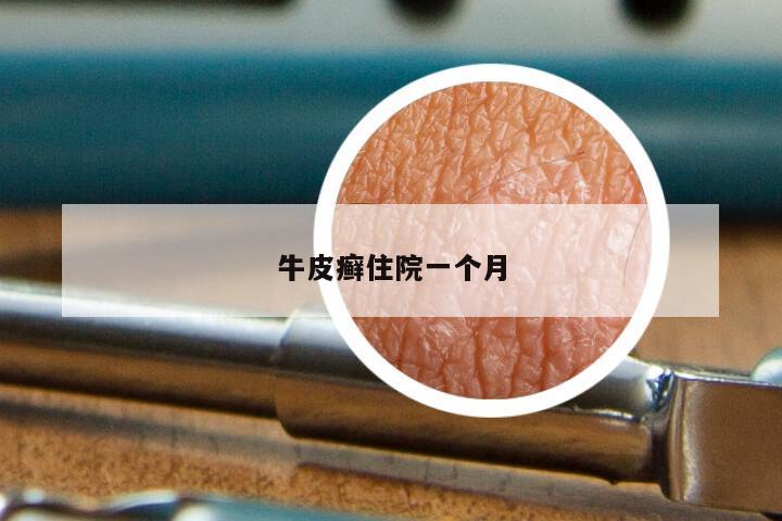牛皮癣住院一个月