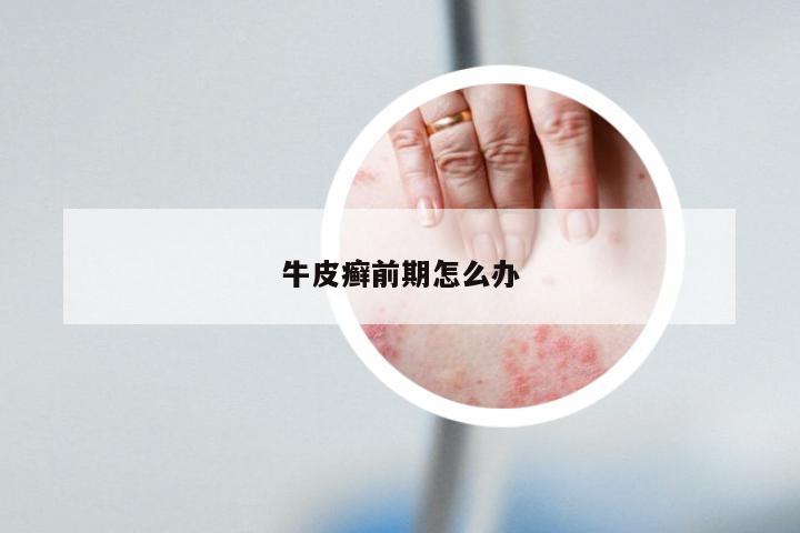 牛皮癣前期怎么办