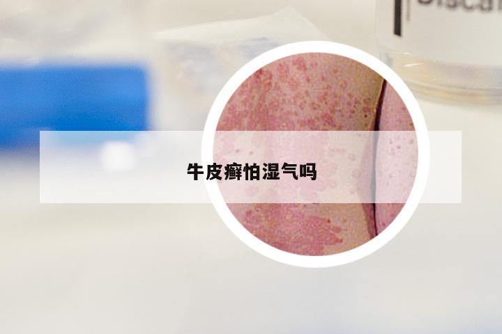 牛皮癣怕湿气吗
