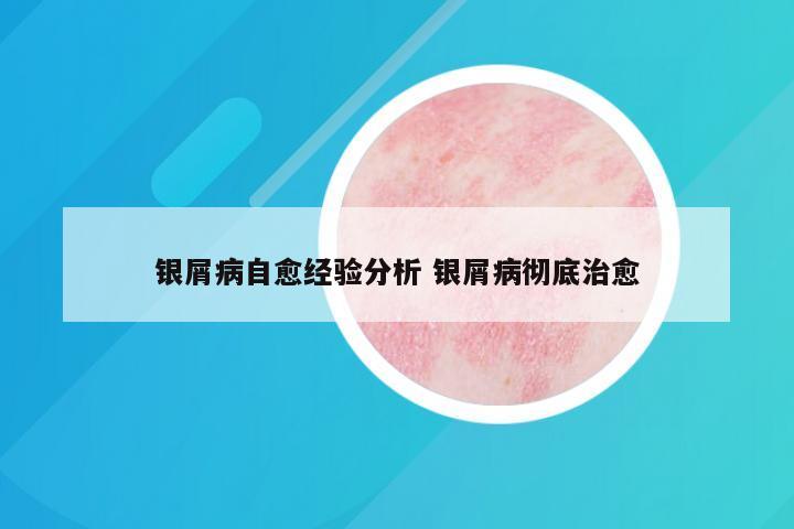 银屑病自愈经验分析 银屑病彻底治愈