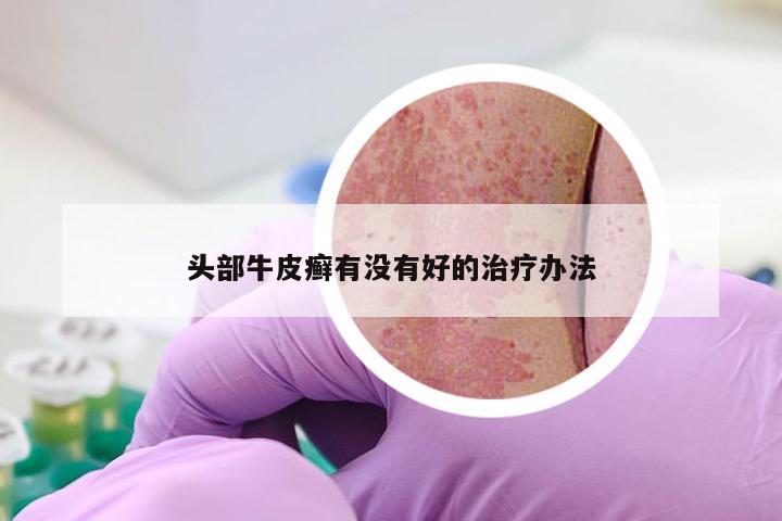 头部牛皮癣有没有好的治疗办法