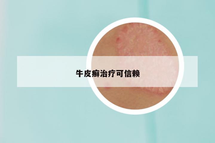 牛皮癣治疗可信赖