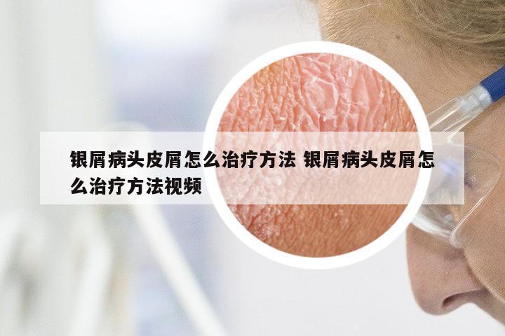 银屑病头皮屑怎么治疗方法 银屑病头皮屑怎么治疗方法视频