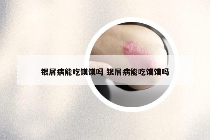 银屑病能吃馍馍吗 银屑病能吃馍馍吗