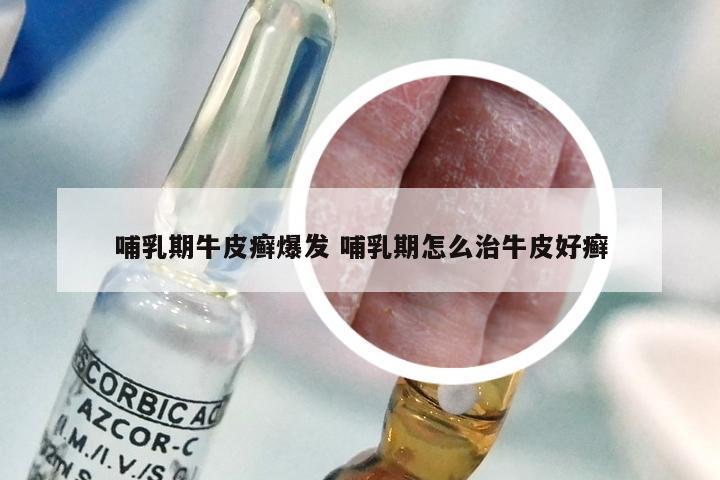 哺乳期牛皮癣爆发 哺乳期怎么治牛皮好癣