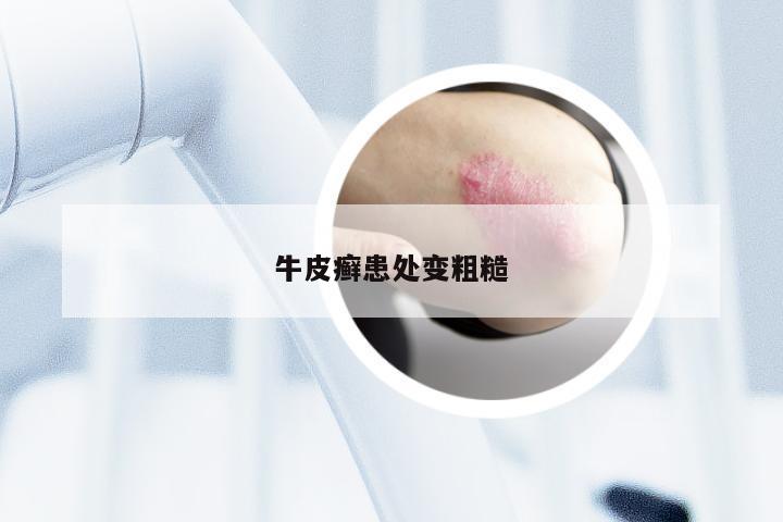 牛皮癣患处变粗糙