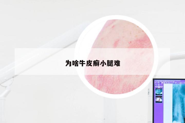 为啥牛皮癣小腿难