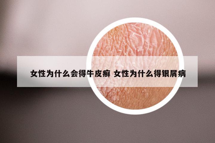 女性为什么会得牛皮癣 女性为什么得银屑病