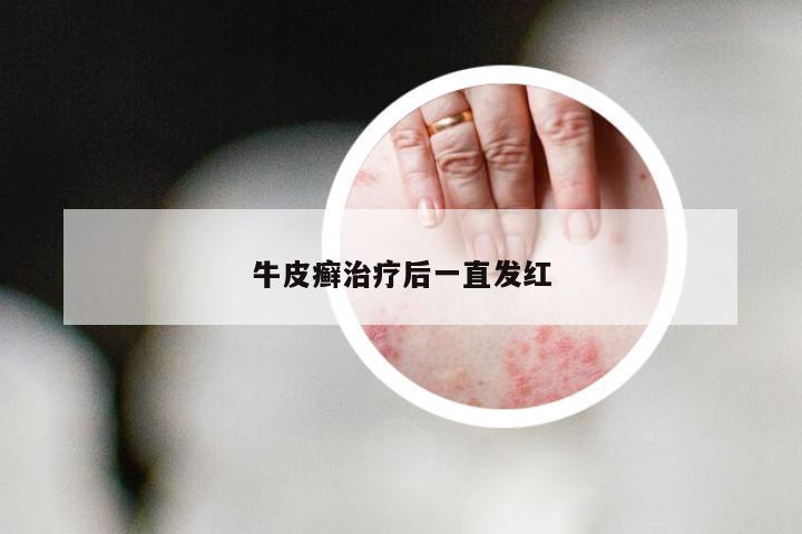 牛皮癣治疗后一直发红
