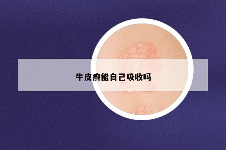 牛皮癣能自己吸收吗