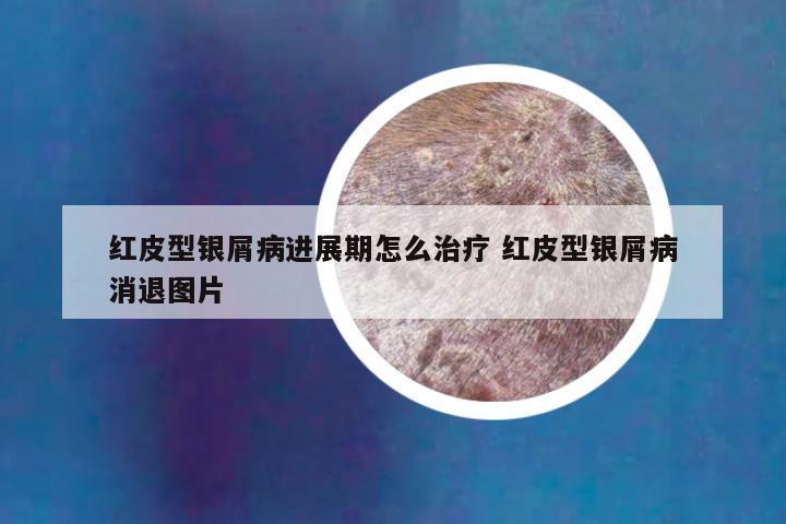 红皮型银屑病进展期怎么治疗 红皮型银屑病消退图片