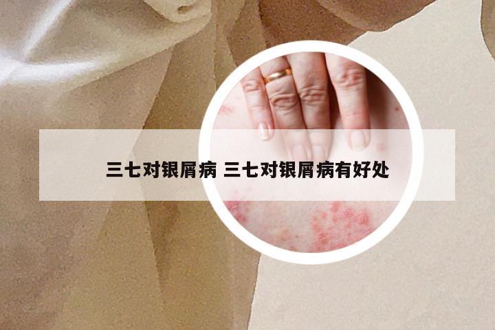 三七对银屑病 三七对银屑病有好处