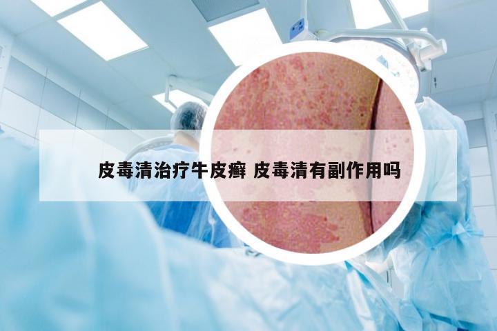 皮毒清治疗牛皮癣 皮毒清有副作用吗