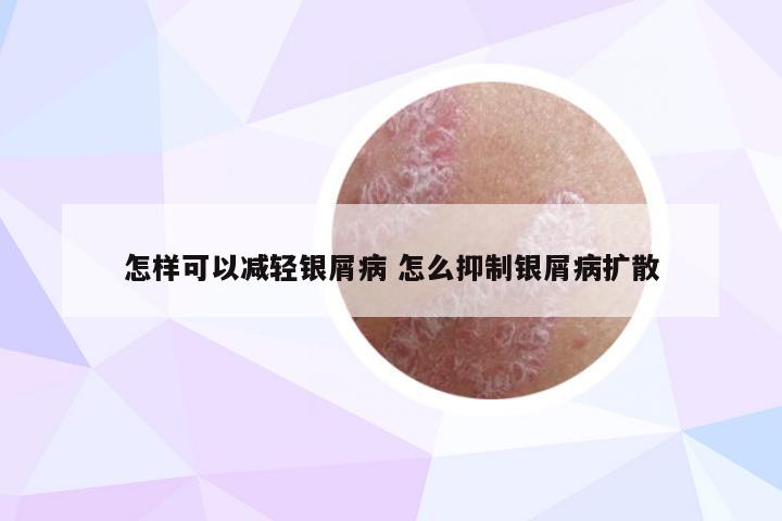 怎样可以减轻银屑病 怎么抑制银屑病扩散