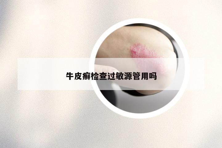 牛皮癣检查过敏源管用吗