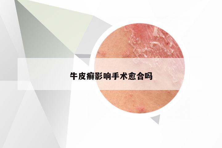 牛皮癣影响手术愈合吗