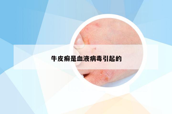牛皮癣是血液病毒引起的