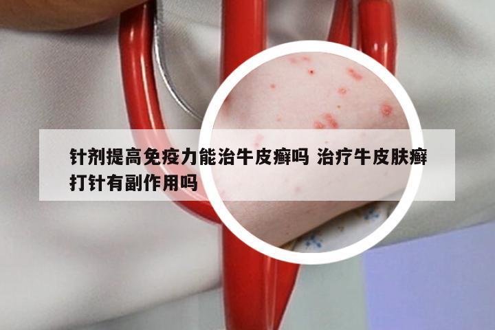 针剂提高免疫力能治牛皮癣吗 治疗牛皮肤癣打针有副作用吗